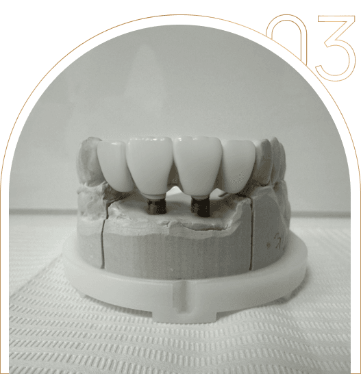 Estetyczne implanty zębowe Estetyczne implanty zębowe w Tychach