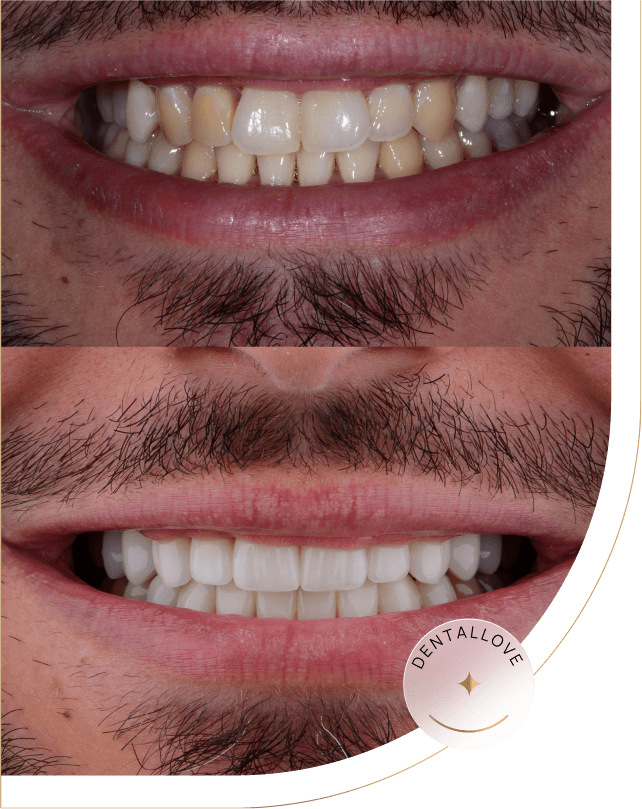 Metamorfozy pacjentów DentalLove