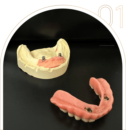 Co to jest proteza na implantach? Co to jest proteza na implantach?