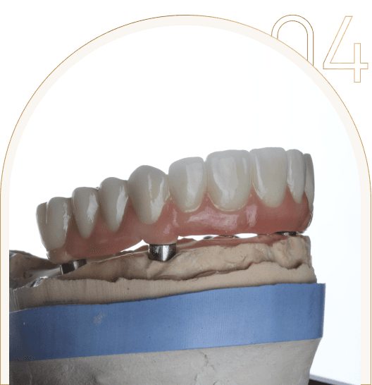 Proteza na implantach Proteza na implantach wykonana w Dental Love
