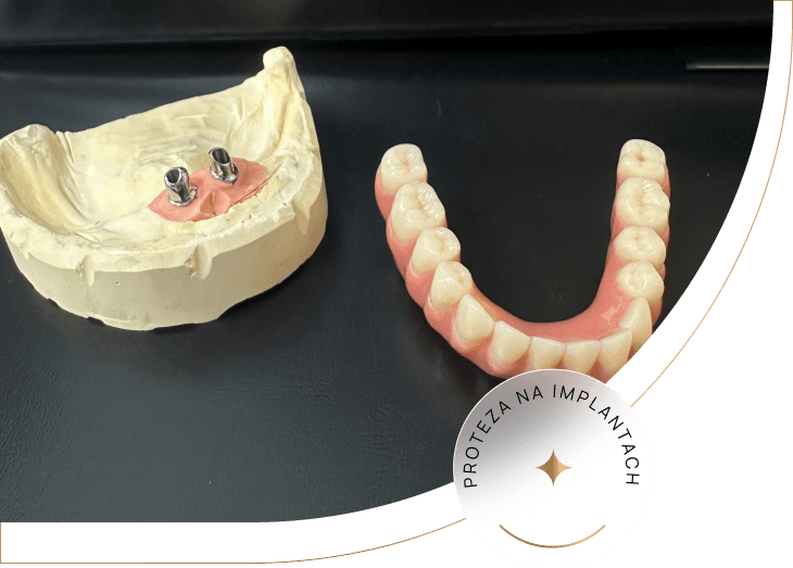 Protezy na implantach Protezy na implantach w Dental Love